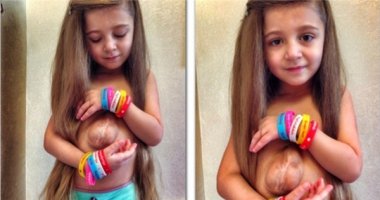 Kinh ngạc với bé gái 5 tuổi có trái tim ngoài lồng ngực