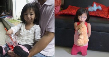 Khâm phục nghị lực phi thường bé gái 3 tuổi không có miệng và tay chân