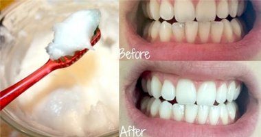 Phương pháp tẩy trắng răng đơn giản và cực hiệu quả sau 7 ngày