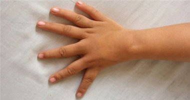 Ngón cái thành ngón trỏ - hội chứng thừa đốt ngón tay