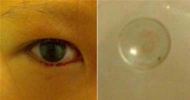 Cô bé 11 tuổi "khóc ra máu" vì đeo kính áp tròng suốt 2 năm