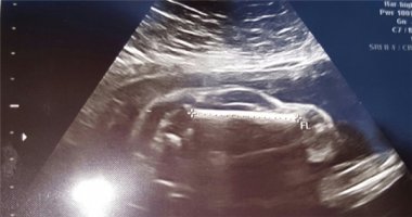 Kinh ngạc trước hình ảnh "bào thai hình xe hơi" trong tử cung người mẹ