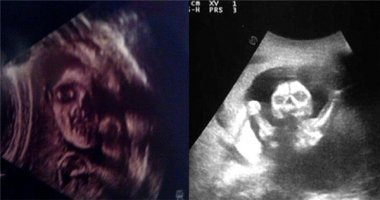 Các bà mẹ giật mình sợ hãi khi xem những bức ảnh siêu âm thai nhi này