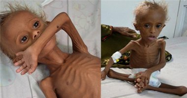 Xót xa hình ảnh em bé chỉ còn da bọc xương ở Yemen vì suy dinh dưỡng