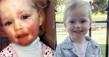 Khuôn mặt cô bé 2 tuổi bị lở loét chỉ vì 1 nụ hôn của người nhà