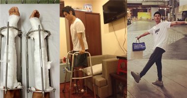 Kéo chân 9cm: Hot boy Hà Nội chia sẻ về “hành trình 1 năm dãn xương”