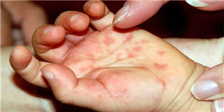 "Rất lo" dịch tay chân miệng bùng phát ở TPHCM bởi không có vaccine phòng ngừa