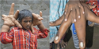 Bệnh lạ khiến cậu bé 8 tuổi có đôi tay khổng lồ