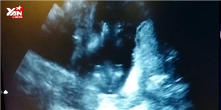Kỳ diệu thai nhi 14 tuần tuổi vỗ tay theo nhịp bài hát trong bụng mẹ