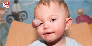 Cuộc phẫu thuật khối u trên mắt của cậu bé dũng cảm gây xúc động