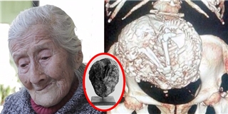 Choáng với cụ bà 91 tuổi mang bào thai hóa đá hơn 60 năm