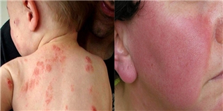 5 bệnh ngoài da thường gặp bị lầm tưởng là bệnh truyền nhiễm