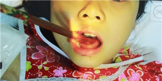 Hãi hùng bé gái 9 tuổi bị đôi đũa cắm xuyên qua lưỡi