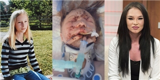 Nghị lực phi thường của cô gái bị xe tông nát mặt