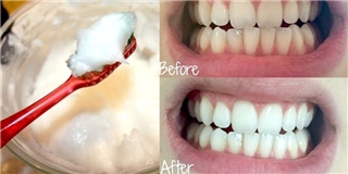 Phương pháp tẩy trắng răng đơn giản và cực hiệu quả sau 7 ngày
