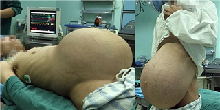 Người đàn ông mang bầu khối u 12,7kg hơn 10 năm
