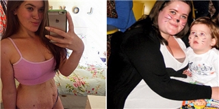 Cô gái quyết tâm giữ lại vùng bụng nhăn nheo sau khi giảm hơn 60 kg