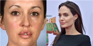 Phẫu thuật để giống Angelina Jolie, người phụ nữ bị biến dạng môi