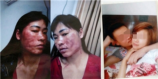 Người phụ nữ bị chồng và nhân tình rạch mặt vì đòi trợ cấp nuôi con