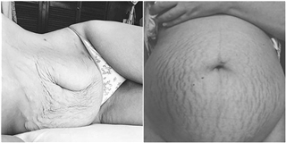 Nghẹn ngào với những hình ảnh về vết rạn da trên cơ thể mẹ