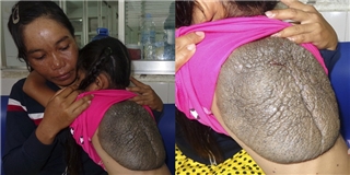 Cô bé mai rùa- trường hợp thứ 2 trên thế giới xuất hiện ở Việt Nam