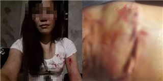 Xót xa phụ nữ bị chồng đánh phải lấy kim tự khâu vết thương cho mình