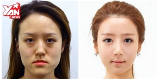 Đây là quá trình phẫu thuật thẩm mỹ Hàn Quốc ít người biết