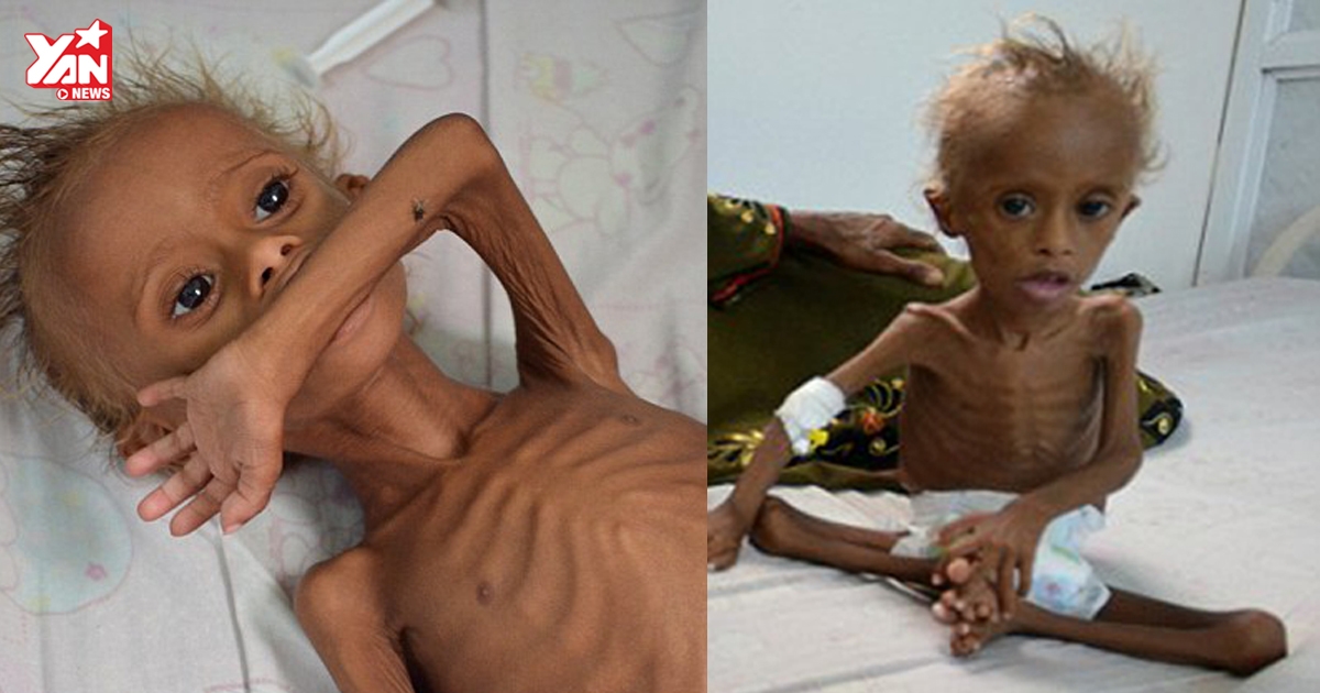Xót xa hình ảnh em bé chỉ còn da bọc xương ở Yemen vì suy dinh