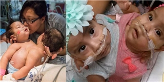 Nín thở với cuộc đại phẫu tách rời thân của cặp chị em sinh đôi 1 tuổi