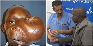Cái kết mĩ mãn cho “dị nhân” mang khối u khổng lồ trên mặt