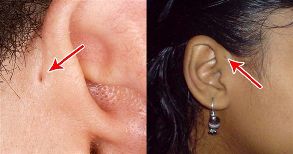 Tại sao một số người có lỗ nhỏ ở vành tai