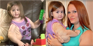 Bệnh lạ khiến cô bé 18 tháng thành phiên bản nhí người khổng lồ Hulk