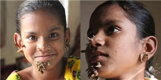 Khuôn mặt biến dạng của cô bé 10 tuổi do mắc bệnh người cây quái ác